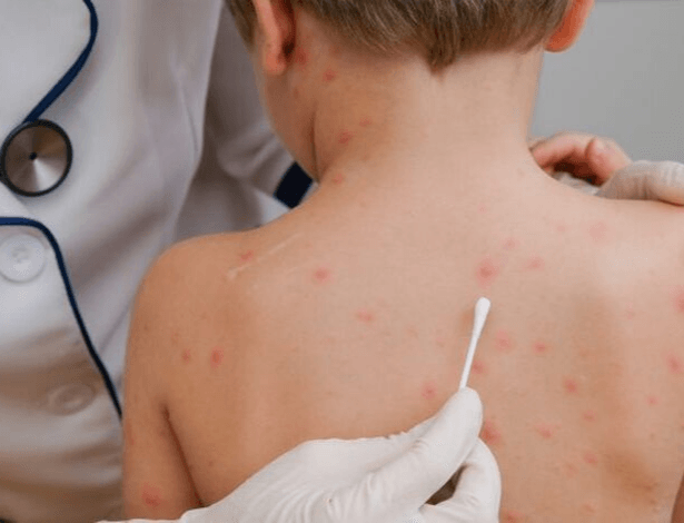 Chicken Pox Kaise Hota Hai